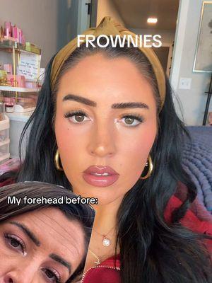 GIRL 🤯💖🥹🙌🏻If you’ve been thinking of starting!!! Now is the time!! Don’t wait because consistency is KEY!! @Frownies  💖 Code- LAURAELLE gets you 10% off #frowniesfacialpatches #frownies #frowniesbeforeandafter #aginginreverse #botoxalternatives 