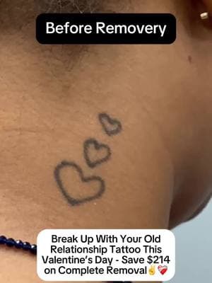 You’ve moved on, and now it’s time to say goodbye for good❤️‍🩹 Enjoy $214 off complete tattoo removal for old relationship tattoos👏 Eligible tattoos: rings, names (including initials), infinity signs, symbolic dates, kings/queens, and hearts. Click the link in our bio to find a studio and schedule your FREE consultation today!🔗 #removery #tattooremoval #lasertattooremoval #tattoo #tattoos #fading #tattoofading #fadingtattoos #tattoocoverup #removetattoos #ustattooremoval #australiatattooremoval #canadatattooremoval #vdaydeals #valentinesdaydeals #vdayoffer #valentinesdaysavings #vdaysavings #removeon #breakupwithyourtattoo #relationshiptattoo #extattoo #exesnametattoo