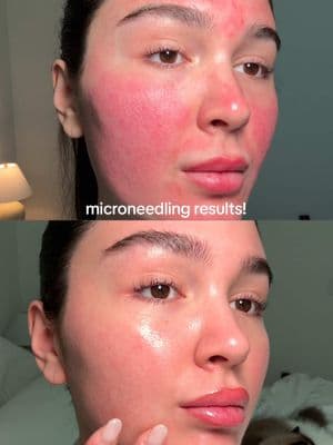 day by day recovery from microneedling! the texture of my skin is SO soft now and i feel like the redness was reduced! i can’t wait for my next session @Timeless Aesthetics 🤭 #microneedlingface #microneedling #beforeandafter #skincare #skincareroutine #microneedlingbeforeandafter #rosacea 