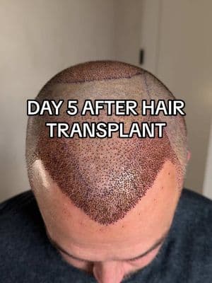 This is how you take care of your new hair at home after a hair transplant #hairtransplant #hairtransplantturkey #hairtransplantsurgery 