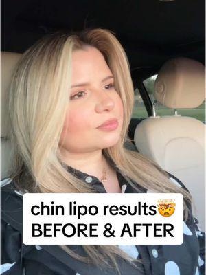 obsessed these chin lipo results 🤯😍 #chinlipo #chinliposuction #chinlipocheck #chinliporecovery #chinlipoupdate #doublechinlipo #doublechin #fyp #fypツ #foryou #foryoupage chin lipo high BMI