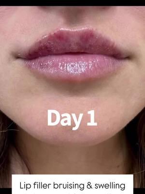 So you wanna get your lips done. But do you need to take off work? What’s the downtime?  Answer 👉🏼 It varies. BUT… you should expect some swelling and bruising, JUST in case.  Day 1: Usually the most swelling. Maybe some bruising.  Day 2: Still swollen and maybe bruised.  Day 3: Swelling has probably gone down a lot, maybe completely. Bruising is fading.  Day 4: looking better!  Day 5: looking much better!  *It can take up to 2 weeks to completely heal.  **The person in the photos was applying @vitalips_lipbalm 3 x a day to speed up the healing process.  Reality: most people go back to work the same day but if you’re going to be in front of a lot of people, take a couple of days off.  But again… EVERYONE is different. Some barely swell at all, some swell a lot. Sometimes there’s no bruising at all. Sometimes there is a lot. It all depends 💁🏼‍♀️ Want to cut down on the swelling and bruising: order  @vitalips_lipbalm to start using immediately after your lip injections. Click the link in my bio to get yours.  #lipfiller #lipfillerbeforeandafter #lipinjections #lipfillerjourney #tampainjector 