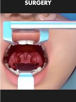 Tonsils Removal Surgery (3D Animation) | Tonsillectomy #tonsillectomy #tonsillitis #tonsilstonesremoval #tonsils #tonsillitisinfection #tonsilremovalsurgery #tonsilremoval #tonsilremoved #medical3danimation #3dmedicalanimation #swollentonsils 