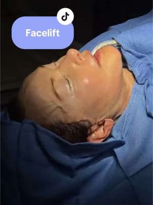 AMA about facelifts ❤️ #drberryfairchild #facelift #plastic #plasticsurgery #face #skin #skincare #beforeandafter 