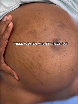 Too many women are silently battling conditions that go unnoticed, misunderstood, or dismissed. This is your reminder to stop asking women if they’re pregnant. You never know the struggle they may be facing. Share this post to spread awareness and help educate others about fibroids. #FibroidAwareness #fibroids #fibroidsolution #fibroidfree #fibroidssuck #womenhealth #womenhealthtips #womenhealthmatters #chicagodoctors #doctorsofinstagram #fibroidslayer #fibroidsurgery #fibroidtreatment 