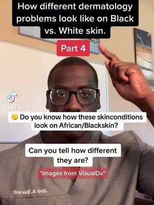 🤔 Do you know how these #skinconditions look on African/#Blackskin? Check out the #facts in this #Tiktok. Credit: @joelbervell#medical #medicalawarness #health #medicalfacts #dermatology#representationmatters #skincare #medical   #knowthesigns #Blackskin #themoreyouknow  #Worldfacts #Blackgirlfollowtrain #Blackmanfollowtrain #Blackmenfollowtrain  #Blacktiktokcommunity #Africantiktok #Africantiktokcommunity #Africantiktokinterntional