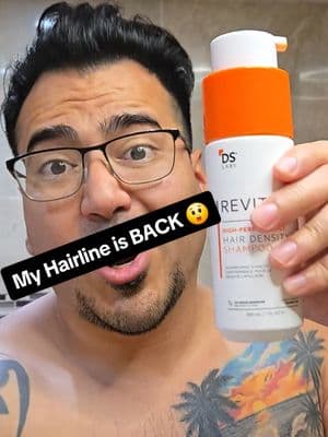 Hairline BACK thanks to Revita! 🙌 Bald spots GONE, baby hairs GROWING—even where I NEVER had hair! See the magic! ✨ #HairGrowthJourney #BaldNoMore #RecedingHairline  #StressPatch #RevitaReview #TikTokMadeMeBuyIt #BeforeAndAfter #HairGoals  #ViralHairProduct #HairTransformation #HairCareRoutine #TikTokViral #HairRestoration 