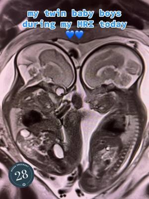 28 weeks gestation, mono/di identical twins in utero, showing head to head during my MRI. 💙💙 #twins #twinmom #twinmomma #picture #mri #uterus #monoditwins #monoditwinboys #monoditwinpregnancy #twinpregnancy #twinpregnancyjourney #twentyeightweekspregnant #28weekspregnant #28weeks #mriscanimages #pregnantlife #pregnancytiktok #pregnanttiktok #pregnanttok #pregnantmomma #fetus 