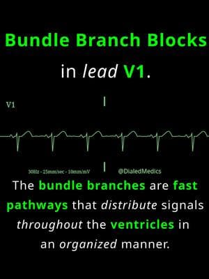 🌱⚠️🫀 Bundle branch blocks are conduction disturbances of the fast electrical pathways which distribute action potentials throughout the ventricles. Bundle branches ensure that ventricular depolarization happens in an organized manner, creating an efficient contraction of ventricular muscle towards ventricular outflow tracts that lead to pulmonary and central circulation. These fast pathways conduct the action potential quicker than the cell to cell transmission of non-specialized myocardium proper. This fast conduction is what results in the normal QRS duration of less than 120ms. When these bundle branches are disrupted the ventricles rely on slower transmission of cells not specialized to conduct signals quickly. This slower propagation results in a wider QRS complex (> 120ms). Anatomically, there are two bundle branches, right and left. Damage to either changes the vector of electrical activity, changing the morphology of the QRS complex in a characteristic way that allows determining which bundle branch is blocked. There are more criteria than just what's visible in V1, but the shape of the QRS complex in V1 is a helpful pointer to which -the right or left- bundle branch is blocked. In this video we see a simple example of how to differentiate left and right bundle branch blocks using the terminal deflection of the QRS complex as seen in V1. A negative terminal deflection (return to baseline) in V1 points to a left bundle branch block. A positive terminal deflection (return to baseline) in V1 indicates a right bundle branch block. All EKG recordings are from the EKG rhythm generator on my website (LII rhythms only for now, 12Ls are in beta and coming soon), be sure to check it out for more software generated #ECG practice! (Link in bio.) #EMS #ACLS #emstok #paramedic #paramedicsoftiktok #medic #medicsoftiktok #flightmedic #criticalcareparamedic #paramedicstudent #paramedicschool #emta #emtb #emt #emtlife #emtsoftiktok #emtstudent #emtschool #firstresponders #NREMT #nurse #nursesoftiktok #RN #nursingstudent #nursingschool #flightnurse #criticalcarenurse #emergencynurse #NCLEX #nclexrn #nclexprep #doctor #doctorsoftiktok #medicalstudent #USMLE #emergencymedicine #criticalcare #cardiology #foamed 