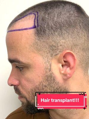 Hair transplant!!!  #hairloss #hairrestoration #hairlossclinic #hairgrowth #hairline #implantecapilar #hair #fue #neograft #miami #transplantedecabello #hairtransplant #fyp #foryou #Viral #lifechanting #parati #trapiantocapelli 