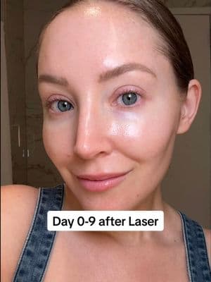 @Thayers Milky Toner 2x a day has helped me heal from laser for YEARS. This is my No.1 must-buy product if you’re getting a laser treatment! #ThayersPartner #Thayers #Thayersmilkytoner #skincare #lasertreatment #skinhealth 