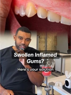 Swollen Gum Remedies from an Oral surgeon #swollengums  #oralcare #inflamedgums 