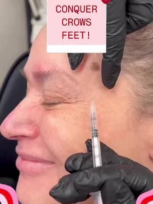 Having your patient animate is a great way to locate your injection points for crows feet! 🤗💉 Learn how to do this and much more at facialesthetics.org   Learn it. Live it. Give it!  Get AAFE Certification trained today! ° °  ° #AAFE #aafecertified #esthetics #facialesthetics #botox #filler #education 