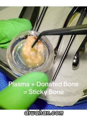 L-PRF (plasma) mixed with allograft (donated bone) for a socket graft in preparation for a dental implant. #plasma #vampirefacial #prf #lprf #socketgraft #dentalimplant 