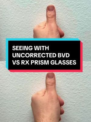 Before I got my prism glasses, this is what I saw: when I focused on my my finger while closing one eye and opening the other, it jumped diagonally instead of staying in one place. My eyes were constantly fighting to align the two images seen by my eyes, making everything unstable and exhausting. But with my prescription prism glasses, my vision finally makes sense—instead of my finger shifting unpredictably, it stays in the same place, and I only notice a natural shift in perspective (parallax). This has completely changed my life. No more: ❌ Constant headaches and migraines ❌ Dizziness and feeling off balance ❌ Eye strain and fatigue from simple tasks ❌ Feeling disconnected from my surroundings ❌ Anxiety from overwhelming visual input ❌ Struggling to focus or process movement ❌ Neck and shoulder tension from constantly adjusting posture ❌ Reading difficulties and losing my place on a page ❌ Sensitivity to lights, screens, and crowded environments ❌ Closing one eye just to see comfortably If you’ve ever felt like your vision isn’t working with you, prism glasses might be the answer. Vivid Visions Optometry, Inc. is located in Valencia, California, and we also offer virtual therapy and consultations to help patients find doctors in their area! 🔗 Schedule an appointment today: www.vividvisionsoptometry.com/appointments #BinocularVisionDysfunction #BVD #PrismGlasses #DoubleVision #EyeStrain #Dizziness #VisualProcessing #Headaches #PrismLenses #NeckPain #ChronicFatigue #DepthPerception #Anxiety #VisionTherapy #VividVisionsOptometry #EyeHealth #NeuroOptometry #BalanceIssues #PrismCorrection