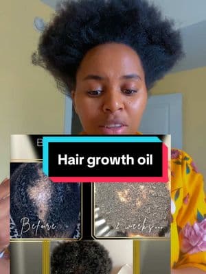 Scalp Stimulator Hair Growth#hair #growth #hairoil #4chair #ti #tiktok #valentine #ValentinesDay #scalp #stimulator #blackfriday #onsalenow️️️🔥🔥🔥🔥 