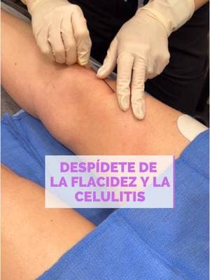 ¡Despídete de la flacidez y las celulitis en los muslos con ATTIVA! 😍 Gracias a su tecnología de radiofrecuencia avanzada, este tratamiento estimula la producción de colágeno desde las capas más profundas de la piel, reduciendo la celulitis, mejorando la elasticidad y moldeando tu figura de forma efectiva ✅💜 . Dile adiós a la flacidez y luce piernas espectaculares con resultados visibles desde las primeras sesiones🫣‼️ #attiva #chinitasbydailyn #miamilakes #estética 