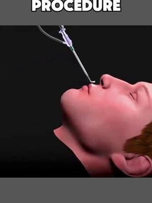 sinuses procedure #sinuspressure #sinusblasty #sinuses #nose #treatment #painful #procedure #watchme #medicalworld161