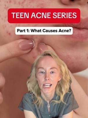 Parents of teens/tweens struggling with acne—let’s break this down. No appointment needed. 👩‍⚕️ Acne isn’t just about washing your face; genetics, hormones, diet, stress, and even sleep all play a role. And yes, some skincare habits might be making things worse! This is just the start of my Teen Acne series—drop your questions in the comments! #TeenAcneTips #DermApproved