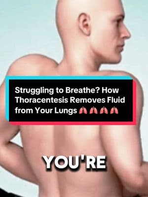 Struggling to Breathe? How Thoracentesis Removes Fluid from Your Lungs! #Thoracentesis #LungHealth #FluidInLungs #BreathingRelief #MedicalProcedure #PulmonaryCare #RespiratoryHealth #DoctorExplains #ChestPain #HealthAwareness #medical #thoracentesis #lungs #lungsurgery #waterremoval #waterremoval 