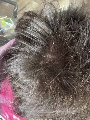 DAY 1 & DAY 2 of a high level lice case! She had animia and severe matted hair….Stay tuned for day 3 of the final treatment tomorrow♥️🩷 you should have seen the smile on her face listening to jelly roll knowing she’s getting lice out #fyp #foryoupage #lice #piojos #headlice #theliceangels #givingback #helping #FY @Bunnie Xo 🪄 