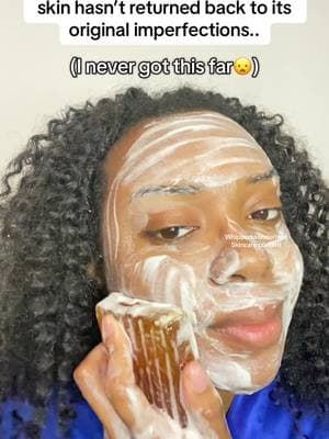 This is REAL😳this soap erased my acne and discoloration so FAST!! #skintransformation #beforeafterskincare #turmericsoap #turmericsoapbar #turmericsoapsoapfordarkspots #helloclearskinsoap #helloclearskinsoapbar #turmericsoap #viralturmericsoap #smallskincarebusiness #naturalskincarebusiness 