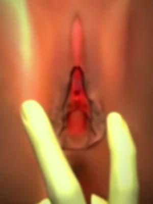 vaginal Rejuvenation Procedure Medical Animation 3D #vaginalrejuvenatio #rejuvenation #medicalprocedure #medicalanimation 