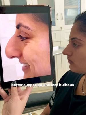 Our beautiful patient is now one year post-rhinoplasty, and the transformation is stunning! Before surgery, she had a slight over-projection of the dorsum, noticeable deviation, and a bulbous tip that felt out of balance with her natural features. Now, her nose is better supported, more refined, and perfectly balanced. The bulbosity has been reduced, and the profile shows a smooth, natural contour that enhances her facial harmony. She loves her results, and we couldn’t be happier for her! At one year post-op, this is the kind of symmetry, proportion, and long-lasting refinement we aim to achieve for every patient. #NoseBySajjadian #BalancedRhinoplasty  #RhinoplastyResults #NaturalNose #NasalSymmetry #BeforeAndAfter #Rhinoplasty #NoseJob #UltrasonicRhinoplasty #PreservationRhinoplasty  #FacialBalance #NaturalBeauty #RhinoplastyJourney