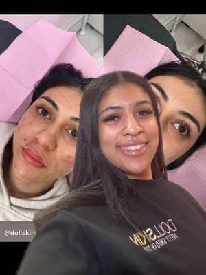 Acné Bootcamp Client Get rid of acne here at our salon in 📍queens ny #nycfacials #nycbootcamp #nycfacereality #greenscreen 