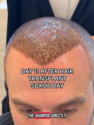 DAY 11 after hair transplant means you can finally scrub your head 🤣#hairtransplant #hairtransplantturkey #hairtransplantsurgery 