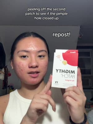 repost 😒 the original video is still up but i’m experimenting with this *slightly edited* video because tt keeps clocking me for no good reason - #herocosmetics #mightypatch #pimplepatch #pimplepatchpeel #pimplepatchremoval #patchpeel #acneskin #acneproneskin #oilyskin #texturedskin #hormonalacne #acneawareness #acnejourney #acnecommunity #foryou #fypage #asian #filipino #newyork 