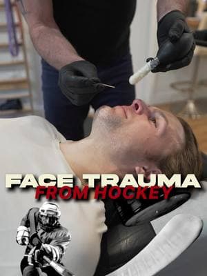 NY local hockey coach came in for the FACE CRACK after years of taking hits on the ice! 🏒🥊  With an old facial fracture and tons of trauma since high school, this adjustment will help him breathe better and feel brand new! 💨✨  . . . #FACECRACK #CFR #BreatheEasy #HockeyLife #Chiropractor #sinusrelief 