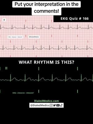 ✨🫀🤔 All #EKG recordings are from the EKG rhythm generator on my website (LII rhythms only for now, 12Ls are in beta and coming soon), be sure to check it out for more software generated #ECG practice! (Link in bio.) #EMS #ACLS #emstok #paramedic #paramedicsoftiktok #medic #medicsoftiktok #flightmedic #criticalcareparamedic #paramedicstudent #paramedicschool #emta #emtb #emt #emtlife #emtsoftiktok #emtstudent #emtschool #firstresponders #NREMT #nurse #nursesoftiktok #RN #nursingstudent #nursingschool #flightnurse #criticalcarenurse #emergencynurse #NCLEX #nclexrn #nclexprep #doctor #doctorsoftiktok #medicalstudent #USMLE #emergencymedicine #criticalcare #cardiology #foamed 