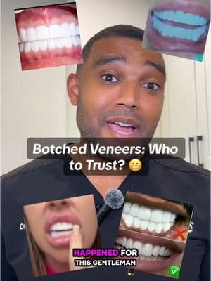 ⚠️Watch THIS before you get veneers #veneers #veneerscolombia #botchedveneers 