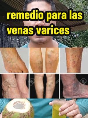 previene y quita las venas varices desde casa #venasvaricosas #varices #piernaslindas #Receta #natural #encasa 