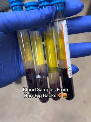 This is what a NORMAL Blood Sample looks like 🥬🍎🥑 Serum and Plasma should be CLEAR and straw yellow color! This doesn’t mean they don’t have underlying diseases, but the color of their samples is considered NORMAL.  Join my community on Skool. Link in Bio. Subscriber ONLY content and lives are focused on CLS students looking to effectively study for their exams! Join our lil community of NASTIES 😝😈 📚🧪🧫🦠🔬 #healthcare #medicine #medtech #medicalhumor #medicaltechnologist #doctor #wellness #healthcareworker #scienceexperiments #laboratory #laboratorio #science #biomedicina #wow #viral #microscope #nurse  #trendingnow #explorepage #iykyk 