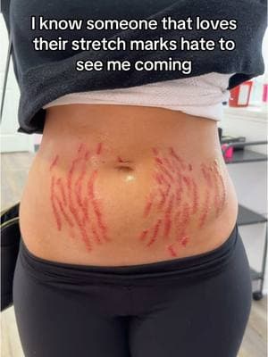 This is our ink-less technique that heals the damaged stretch mark skin with natural vitamins 🧪 Once the inflammation goes down these stretch marks will be faded and healed! #enluvbeautylounge #stretchmarkremoval #stretchmarkcamouflage #inklessstretchmarkremoval #stretchmarksremedy #stretchmarksbegone #braziliancamouflagetattoo #paramedicaltattoo #paramedicaltattooartist #stretchmarksolution #tattoostretchmarks #stretchmark #braziliancamouflage #stretchmarktattoo #postpartumbody 