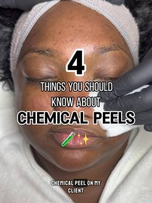 4 things you should know about Chemical Peels! 🧪✨ 1. How to prep for a Chemical Peel Discontinue the use of any exfoliants and prescription topical medications (like tretinoin) at least 7 days prior to getting a chemical peel. 2. Different types of Chemical Peels Chemical peels come in different strengths. There’s superficial peels that target the skin’s outermost layer and have little to no downtime. Medium chemical peels which is what I’m doing on my client today— which penetrate deeper, causing some peeling, and requires a few days for the skin to recover. And then we have deep chemical peels which make your skin shed like a snake but provide dramatic results. 3. You might not peel as expected The amount of visible peeling doesn’t always indicate effectiveness. Even if you don’t see much peeling, the treatment is still working on a cellular level. Visible peeling varies from person to person and  depends on the kind of peel that is done. If you frequently exfoliate with chemical exfoliants you also might not peel too dramatically because your skin is already accustomed to exfoliation. 4. Post-Peel care is crucial After getting a chemical peel, be sure to avoid sun exposure and always wear SPF. I recommend wearing at least SPF 30 and reapplying throughout the day when needed. Keep your skin care routine simple and gentle. Avoid chemical exfoliants, _prescription topical medication, heavy sweating, hot showers, and makeup for at least 7 days after. Don’t pick at peeling skin! It could lead to scarring and hyperpigmentation. @Shanti Skincare NYC  Join the waitlist at www.shantiskincarenyc.com/waitlist 💚 #nycfacials #nycskincare #nycesthetician #nycchemicalpeels #chemicalpeel #chemicalpeels