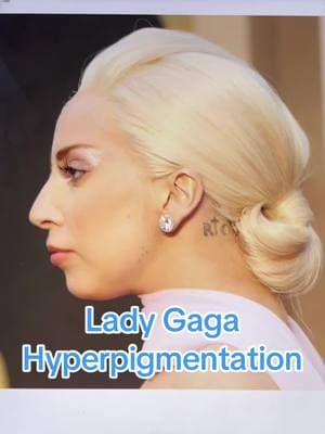 What would Lady Gaga look like if she had a face like hyperpigmentation? #ladygaga #hyperpigmentation #hyperpigmentationtreatment #fyp #makeover #growingup #trending #abracadabra 