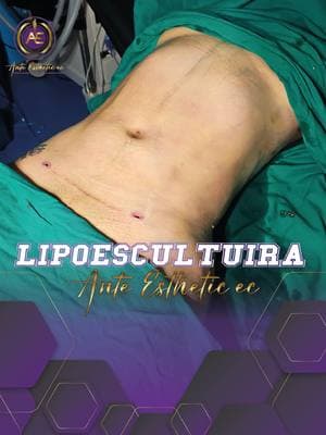 Transforma tu Cuerpo con Lipoescultura! 💫**   🌟 **Beneficios que Amarás**:   ✅ Moldea tus curvas al máximo �   ✅ Recuperación rápida y segura ⏳🩺   ✅ Resultados naturales y personalizados 💃   **🔥 ¡Promoción Especial! 🔥**   📅 **Solo hoy**   ✨ **20% de descuento**   ✨ **Consulta gratis** + Plan de pagos flexible 💳   **📣 ¡Actúa Ya!**   👉 ¿Lista para lucir tu mejor versión? **¡Agenda hoy!**   🔗 **DM**   💄 *También ofrecemos otras cirugías estéticas: rinoplastia, aumento de glúteos, y más.*   **#Lipoescultura #BellezaSinLímites #OfertaEspecial #CuerpoSoñado 😍**   **#ClínicaDeEstética #Promo2025 💖**  