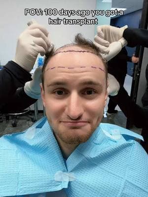 It’s coming together #hair #hairtransformation #hairtransplant #hairgrowth #update 