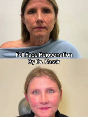 “I feel like my face drooped over the past 3 years and I just wanted to look like myself just refreshed. Dr. Kassir you truly are an artist and made me look 20 years younger! I can not thank you enough for changing my life ❤️” says our lovely patient 3 months post-op.  Our amazing patient is 59 years young Nurse 👩🏻‍⚕️ and came from Connecticut for full face rejuvenation.  Concerns ⬇️ - She disliked her droopy midface  - Forehead wrinkles  - Excess neck skin  - Heavy brows & excess eyelid skin - Skin texture  Game Plan ⬇️ We performed the following procedures to give her a natural & fresh look: 1️⃣ Deep Plane Face & Neck Lift 2️⃣ Endoscopic Brow Lift 3️⃣ Upper Blepharoplasty 4️⃣ CO2 Fractional Laser She is now 3 months post-op and is in love with her results! She feels great & love how natural her results are. We will continue to keep track of her healing and show you all the progress! Stay tuned for her follow up pictures 🤗 To schedule an appointment:   ☎️ 212-288-3000  📲 WhatsApp: 201-875-8482 💌DM  Locations: 📍65 East 66th Street, New York, NY 10065 📍81 North Maple Avenue, Ridgewood, NJ 07450 #bestfacelift #facelift #faceliftnyc #faceliftnj #necklift #faceliftbeforeandafter #over50 #faceliftjourney #eyelidsurgery #beforeandafterfacelift #browlift #scarsafterfacelift #viral  Disclaimer: I do not own or claim to own the audio in this video. All rights and permissions are granted to the owner of this sound.