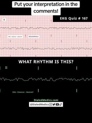 ⚠️☠️🤔 All #EKG recordings are from the EKG rhythm generator on my website (LII rhythms only for now, 12Ls are in beta and coming soon), be sure to check it out for more software generated #ECG practice! (Link in bio.) #EMS #ACLS #emstok #paramedic #paramedicsoftiktok #medic #medicsoftiktok #flightmedic #criticalcareparamedic #paramedicstudent #paramedicschool #emta #emtb #emt #emtlife #emtsoftiktok #emtstudent #emtschool #firstresponders #NREMT #nurse #nursesoftiktok #RN #nursingstudent #nursingschool #flightnurse #criticalcarenurse #emergencynurse #NCLEX #nclexrn #nclexprep #doctor #doctorsoftiktok #medicalstudent #USMLE #emergencymedicine #criticalcare #cardiology #foamed 