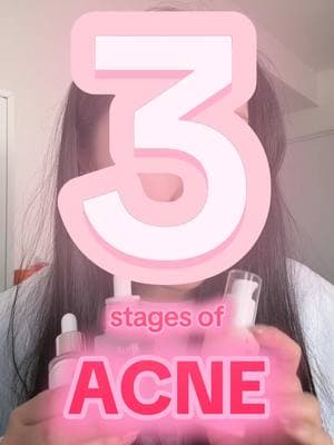 Skincare recommendations for all 3 stages of acne! Products mentioned: Seoul 1988 Retinal Serum, Anua PDRN + Hyaluron Serum, Dear Klairs Freshly Juiced Vitamin Drop 🌟 #acne #acneproneskin #acneskincare #hyperpigmentation #kbeauty #koreanskincare #seoul1988 #anua #dearklairs @KSECRET GLOBAL @anua_global @Klairs Global Official 