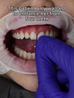 Limited front four veneers 🦷 how many veneers would you get? 🤔💭 #frontteeth #porcelainveneers #veneers #dentalveneers #closinggaps #teethgap 