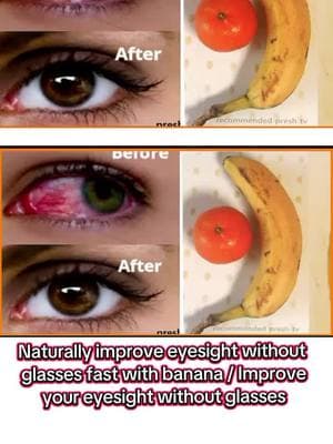 Naturally improve eyesight without glasses fast with banana / Improve your eyesight without glasses#e #health #eye #eyehealth #eyesight #eyesight 