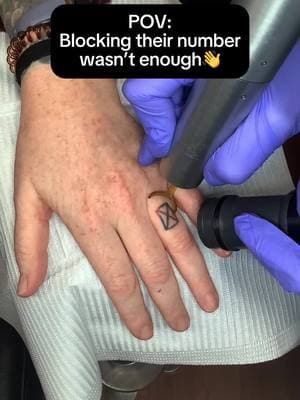 The final chapter of this love story: removal. 📖💀 Only 1 day left to save $214 off complete tattoo removal for old relationship tattoos❤️‍🩹 Offer ends tomorrow - book now⏳ #removery #tattooremoval #lasertattooremoval #tattoo #tattoos #fading #tattoofading #fadingtattoos #tattoocoverup #removetattoos #ustattooremoval #australiatattooremoval #canadatattooremoval #vdaydeals #valentinesdaydeals #vdayoffer #valentinesdaysavings #vdaysavings #removeon #breakupwithyourtattoo #relationshiptattoo #extattoo #exesnametattoo