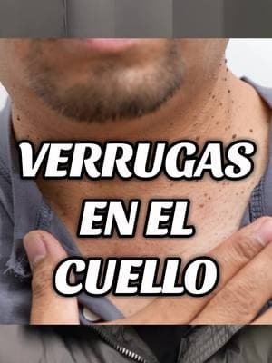 Manchas negras y verrugas en el cuello síntoma de resistencia a la insulina. Esto es como comienza la diabetes, acompañado con el sobre peso. #prediabetes #diabetestipo2 #diabetes 