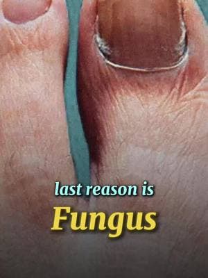 😱 Why You KEEP Getting Ingrown Toenails! 🚨 If your toenails keep getting ingrown, one of these might be the reason: 1️⃣ Genetics – Some people are just unlucky with curved or wide nails 👀 2️⃣ Bad Shoes – Tight-fitting shoes crush your nails and make ingrowns worse 👟 3️⃣ Fungus – Nail fungus changes the nail shape, making ingrowns more likely 🤢 ⚡ Stop the cycle! If you're in pain, don’t wait—get it removed ASAP. 📍 In Tampa Bay? We can help! Book an appointment today: https://healthyfeetpodiatry.com/ #IngrownRemoval #ToenailFix #HealthyFeet #FootPain #Podiatry