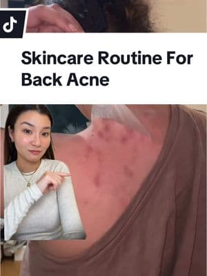 How I cleared my back acne with the right products, patience and consistency. Hope this helps: @Selflove_aida #backacne #bodyacne #bodyacnetreatment #backacnetreatment #backacnetips #bodyacneroutine #bodyacneproducts #bacne #bacnetreatment #bodycareproducts #bodycareroutine #bodycaretips #greenscreen #greenscreenvideo @SOME BY MI US @Murad Skincare @Glytone @StriVectin 